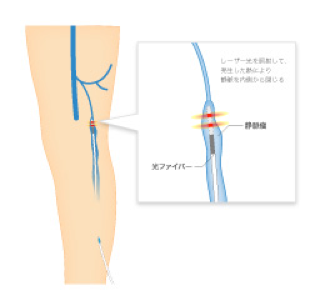 血管内焼灼術のメリット