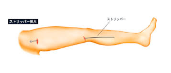 3.ストリッピング手術