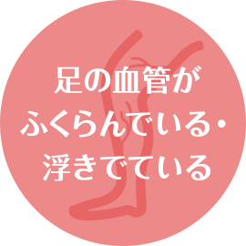 足の血管がふくらんでいる・浮きでている