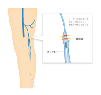 レーザー治療のメリット